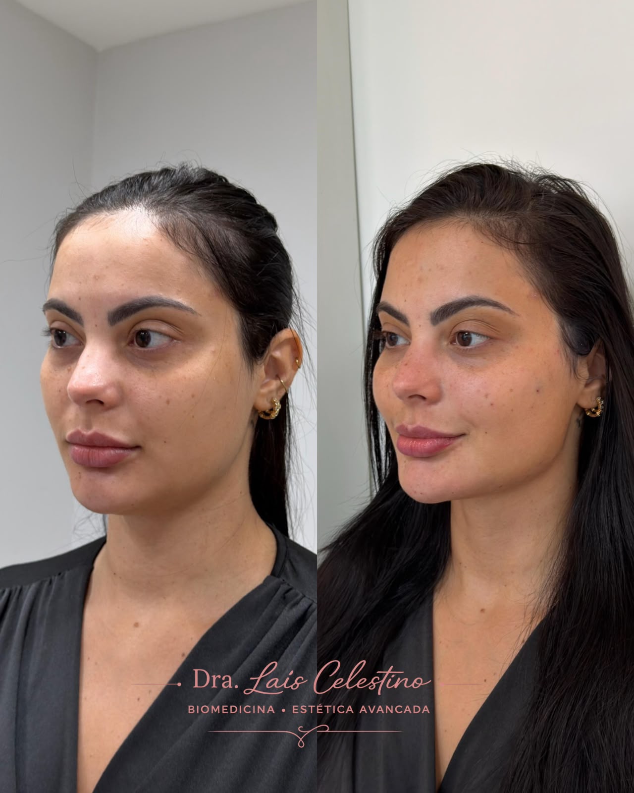 Resultado real de planejamento facial 3