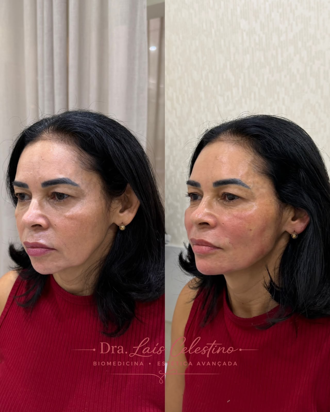Resultado real de planejamento facial 1