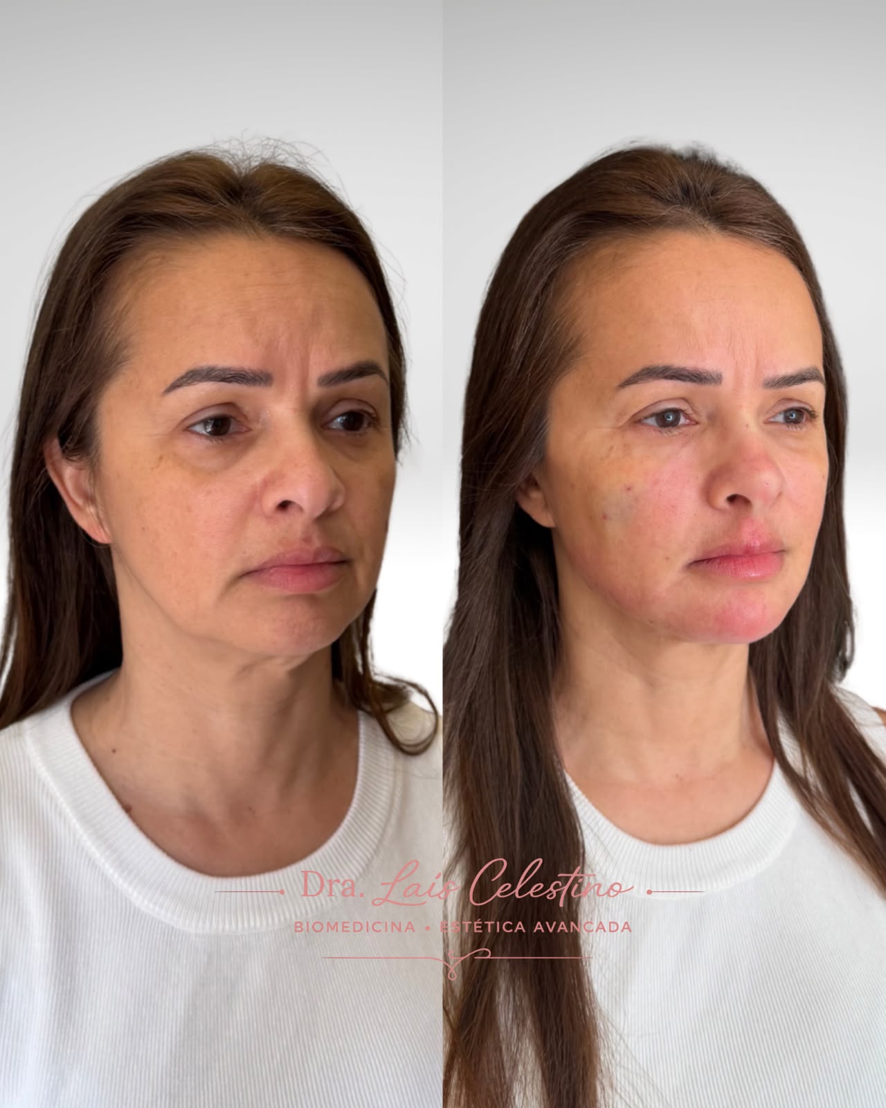 Resultado real de planejamento facial 5