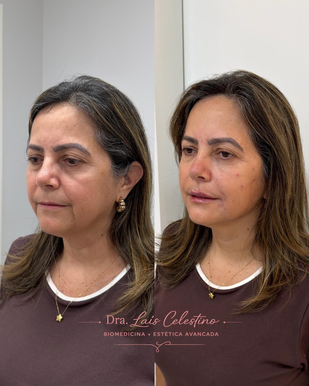 Resultado real de planejamento facial 4