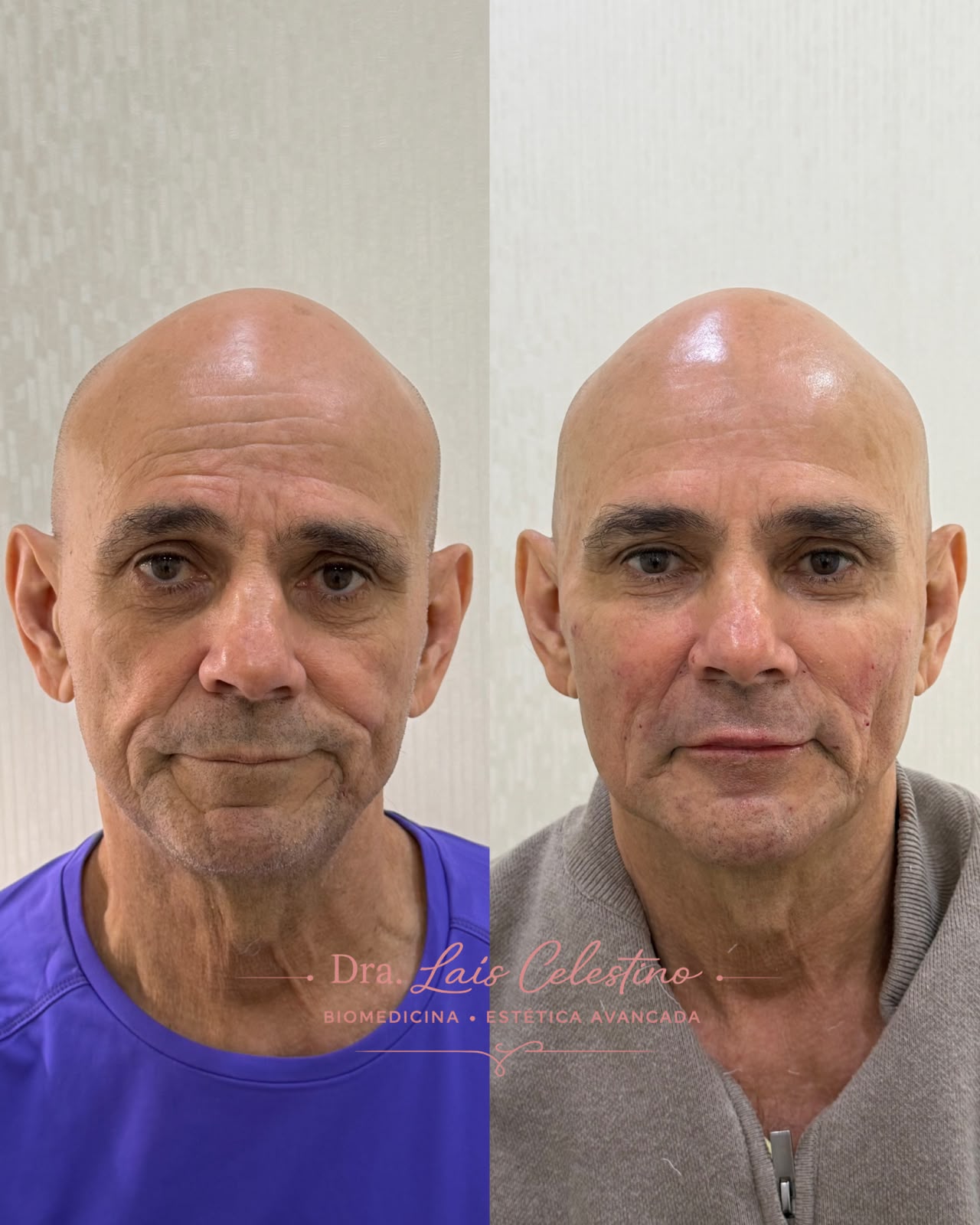 Resultado real de planejamento facial 6
